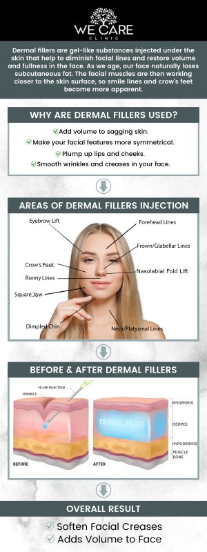 Dermal fillers are non-surgical injectable treatments that restore volume, smooth wrinkles, and enhance facial contours. At We Care Clinic in River Oaks, TX, Dr. Shabnam Qasim, MD, a Board-certified physician, and our team of experienced nurse practitioners provide customized treatments focused on achieving natural-looking balance. Dermal fillers offer noticeable rejuvenation with minimal downtime and long-lasting results. For more information, contact us or schedule an appointment online. We are conveniently located at 1011 Roberts Cut Off Rd, River Oaks, TX 76114.
